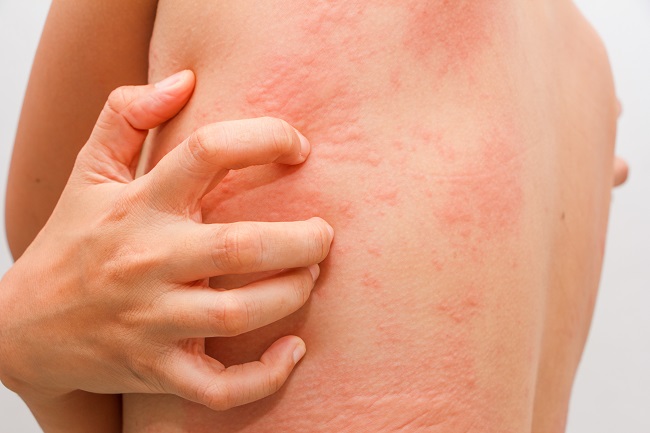 What You Need to Know About Hives